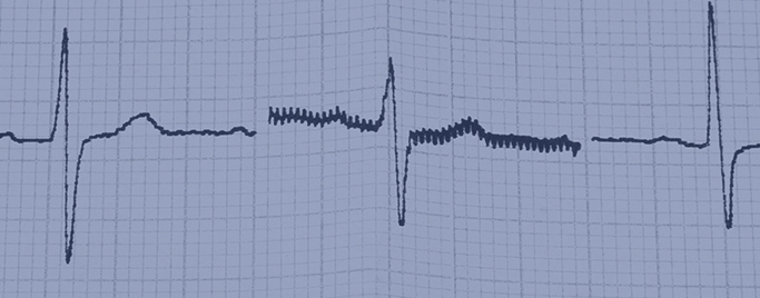 EKG - Terheléses EKG